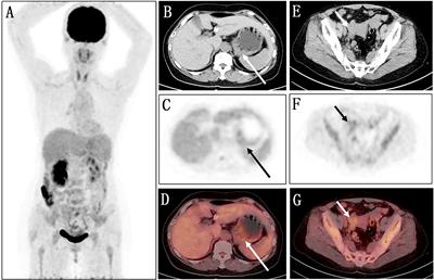 Case Report: 68Ga-FAPI PET/CT, a more advantageous detection mean of gastric, peritoneal, and ovarian metastases from breast cancer